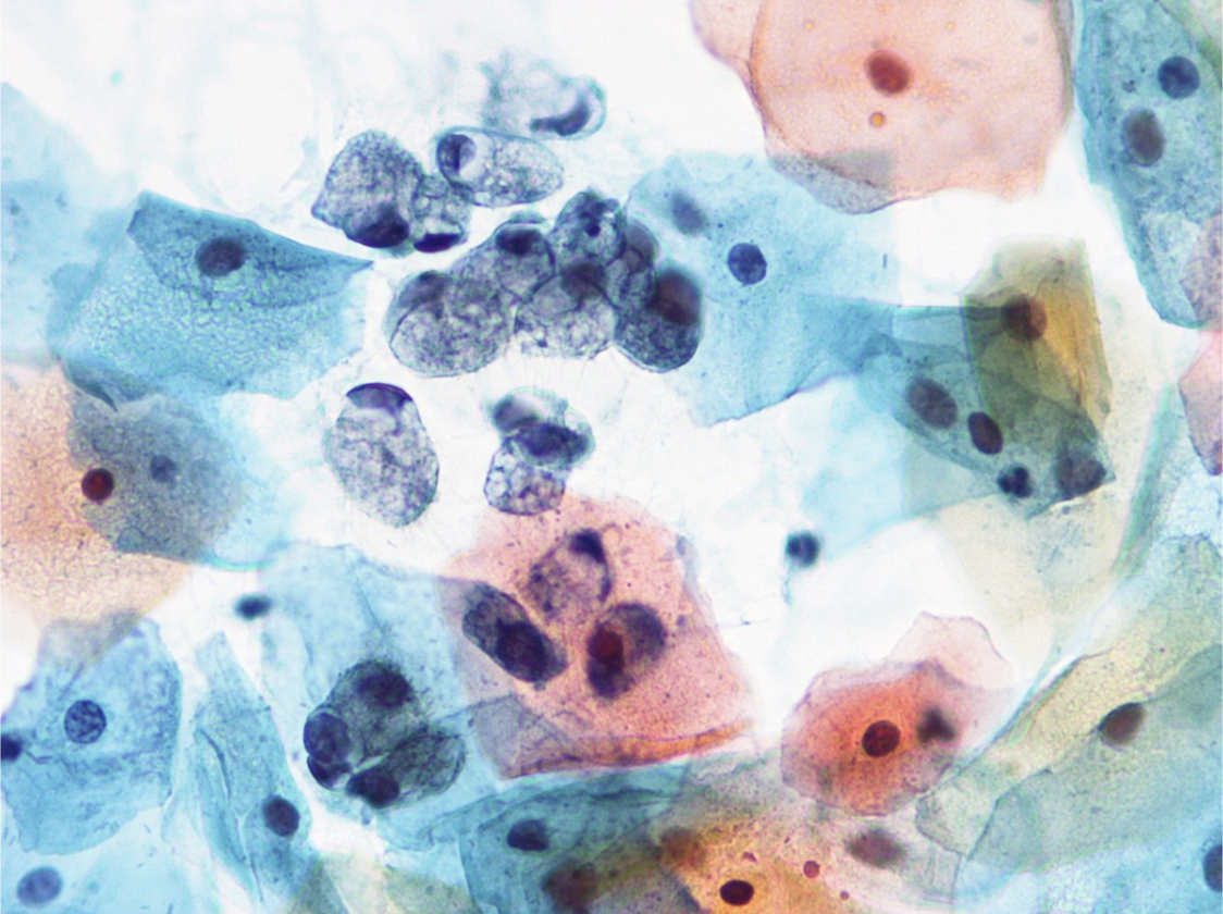 Picture 3 : ภาพแสดงตัวอย่างเซลล์ที่พบจากการส่งกล่องตรวจ Vaginal Cytology